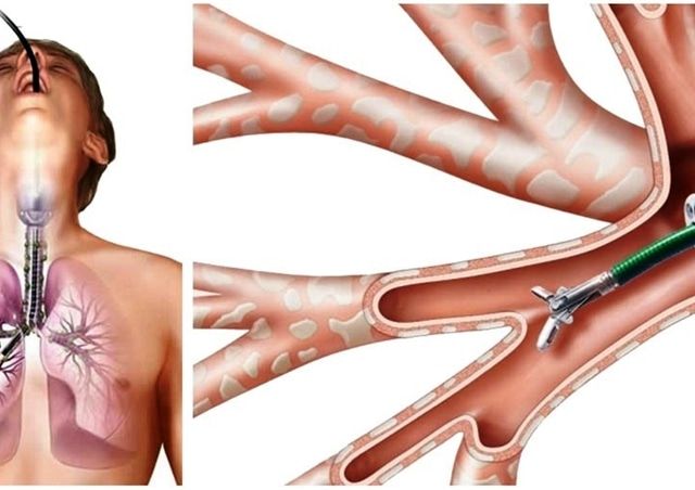 brokoskopi-drfusun-eyuboglu