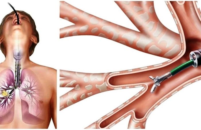 brokoskopi-drfusun-eyuboglu