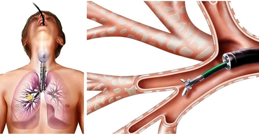 brokoskopi-drfusun-eyuboglu